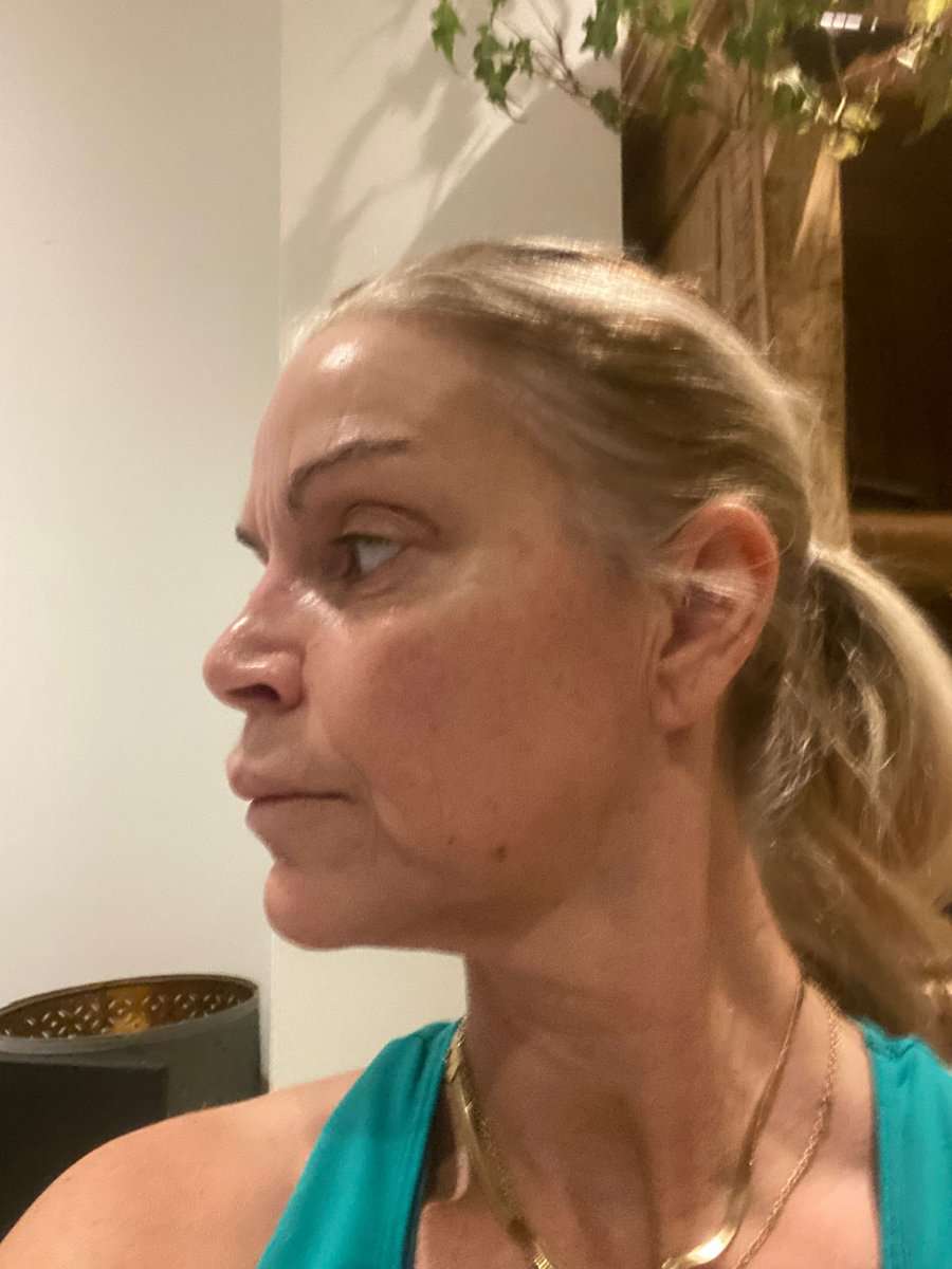 Martine, facelift in Turkije, voor de operatie