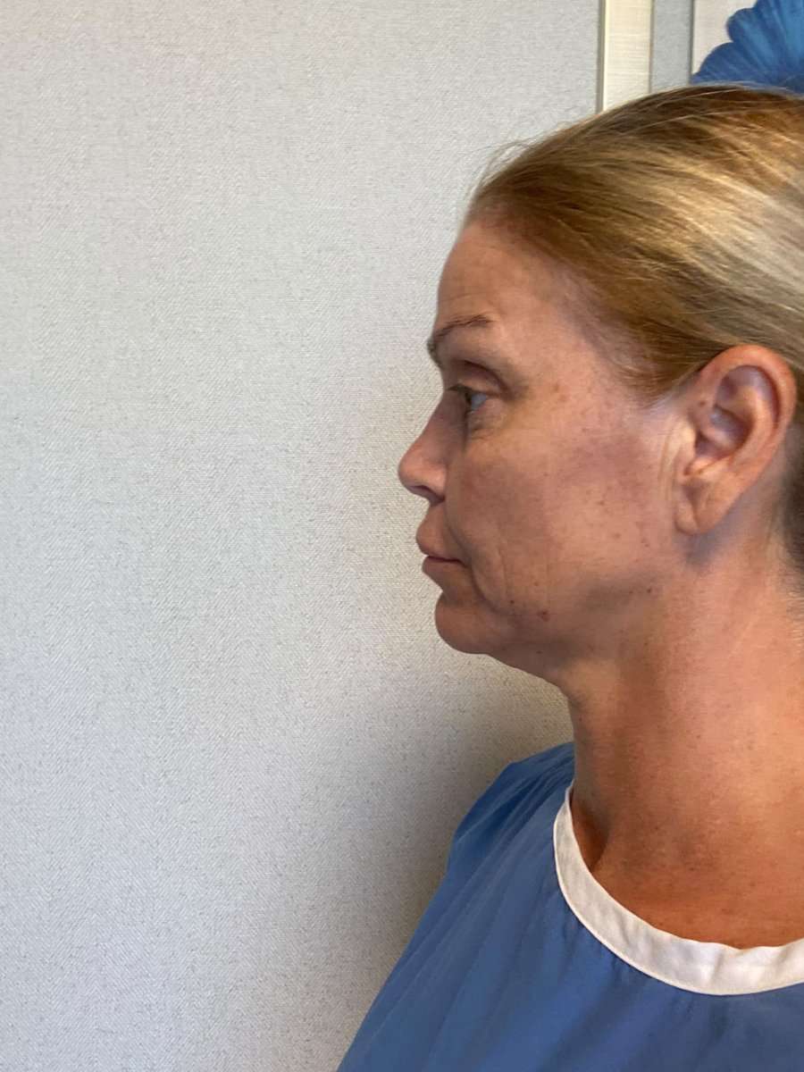 Martine, facelift in Turkije, voor de operatie