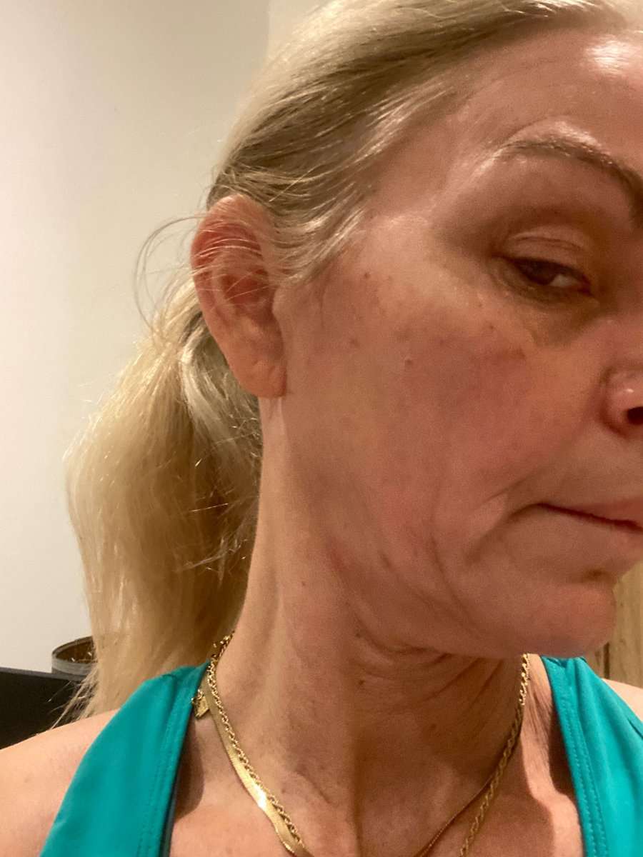 Martine, facelift in Turkije, voor de operatie