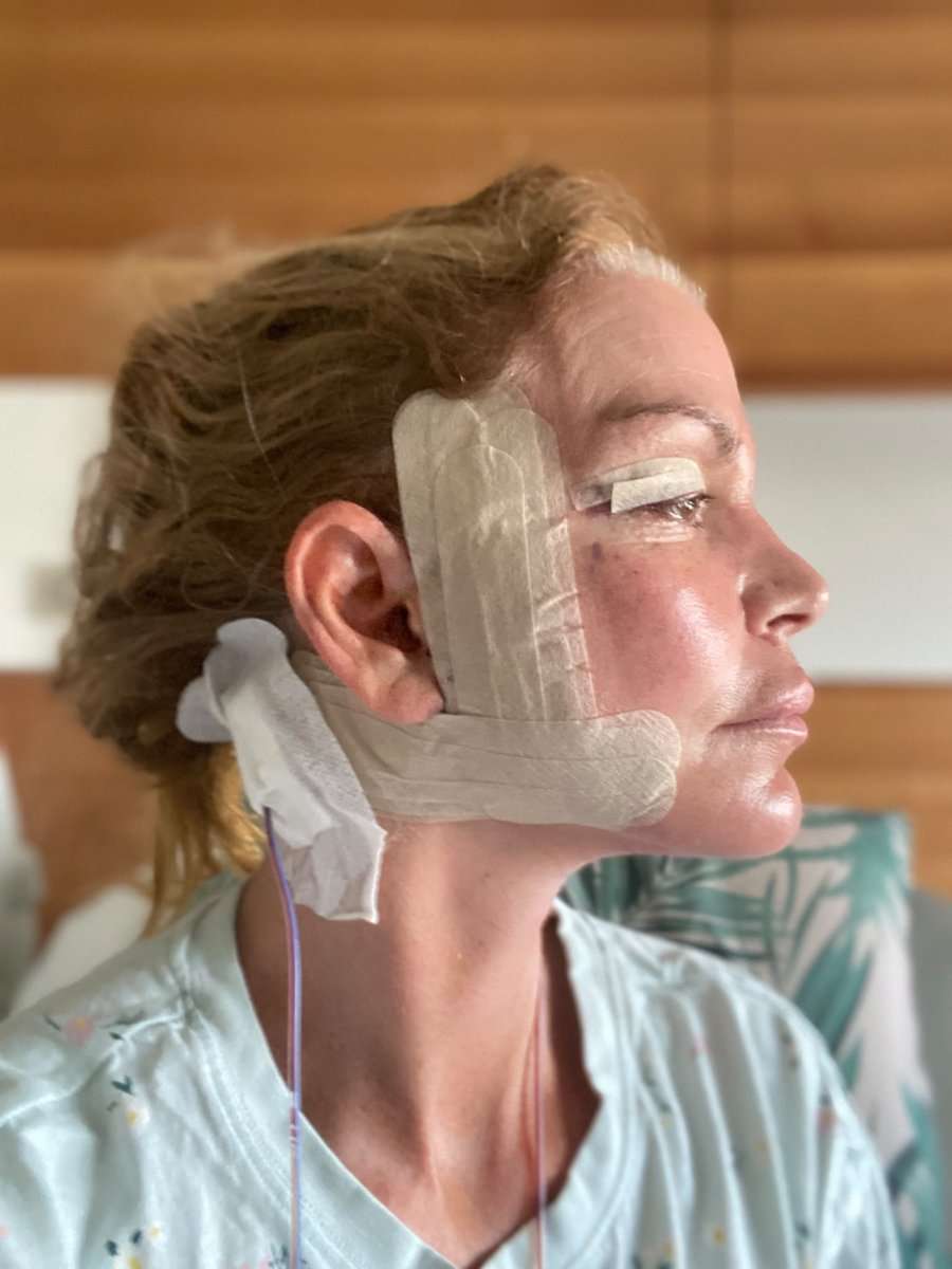 Martine, facelift in Turkije, in het ziekenhuis