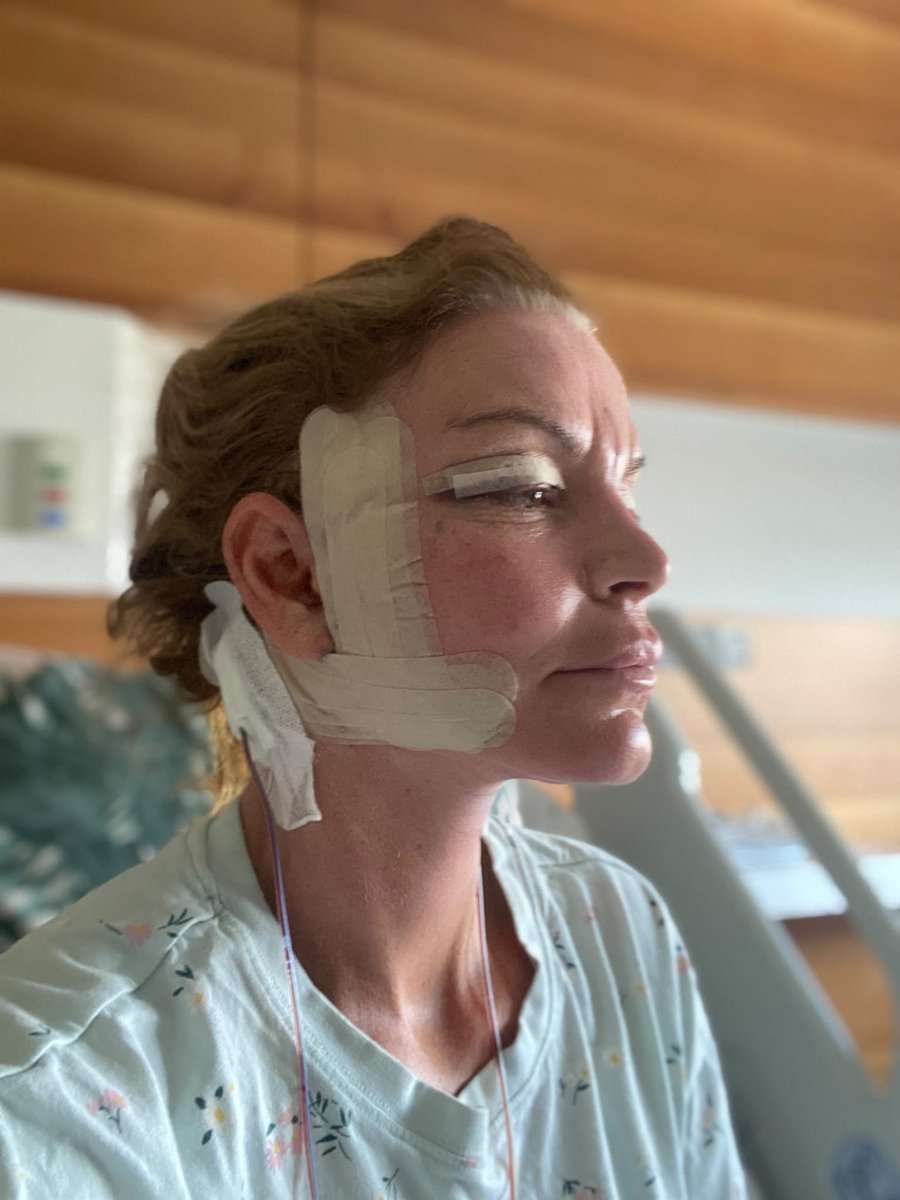 Martine, facelift in Turkije, in het ziekenhuis